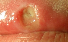 Ağız Yarası İçin İlaç Kullanımı ve Faydaları Nelerdir?