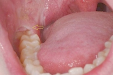 Çoçuklarda Ağız İçi Yarası Bitkisel Tedavi