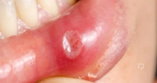 Stresten Ağız Yarası Belirtileri ve Tedavisi