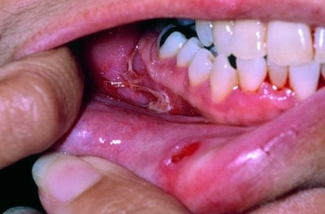 Ağız İçindeki Yaralara Ne İyi Gelir?