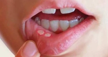 Bebeklerde Ağız Yaraları Belirtileri ve Tedavisi