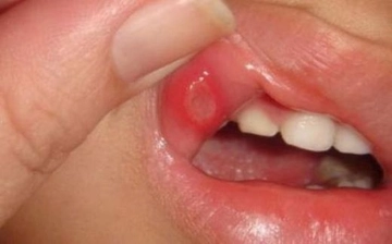 Behçet Hastalığı Ağız Yaraları Belirtileri ve Tedavisi